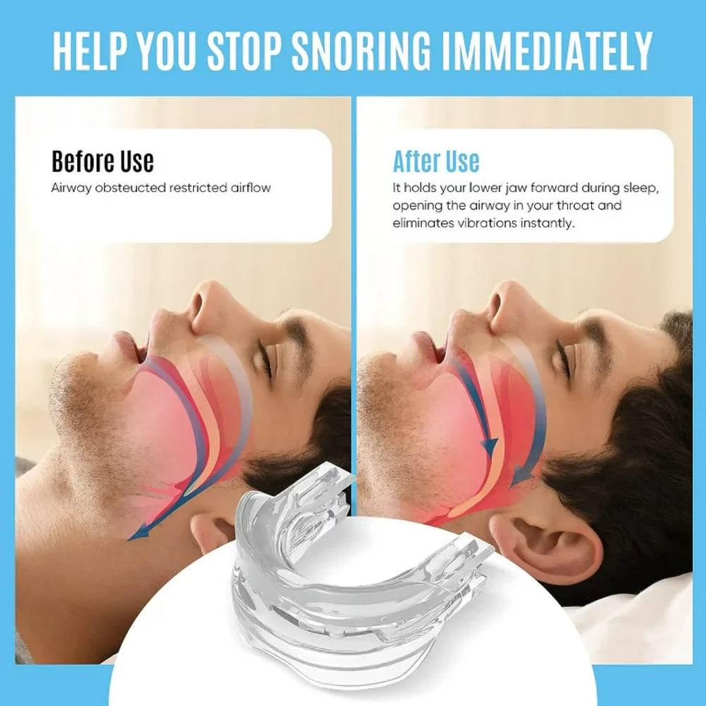 SleepPure | Anti-Schnarch-Schiene gegen Schlafapnoe