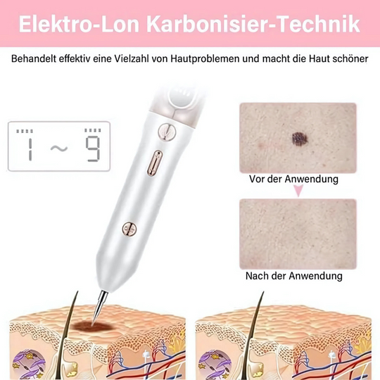 Skinea | Plasma-Stift zur sicheren Entfernung von Hautmakeln