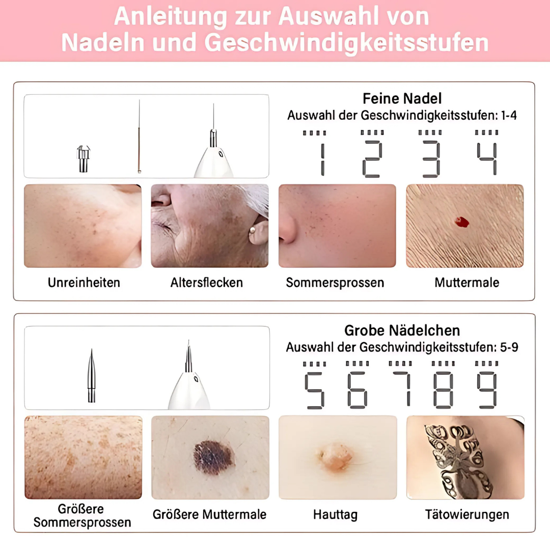 Skinea | Plasma-Stift zur sicheren Entfernung von Hautmakeln