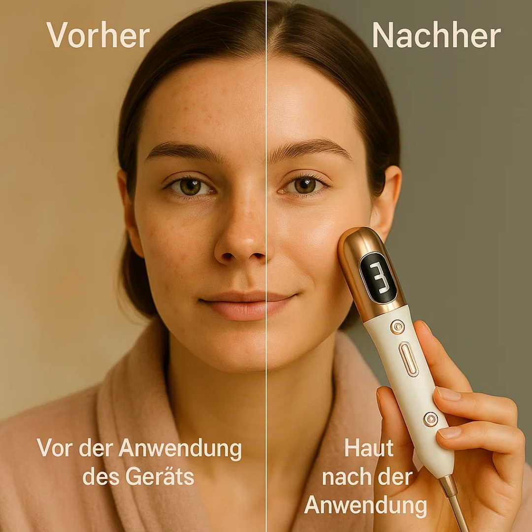 Skinea | Plasma-Stift zur sicheren Entfernung von Hautmakeln