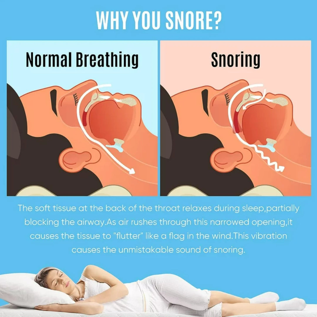 SleepPure | Anti-Schnarch-Schiene gegen Schlafapnoe