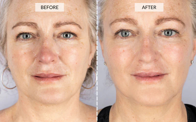 YouthRay | LED Lichttherapie Maske