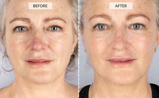 YouthRay | LED Lichttherapie Maske