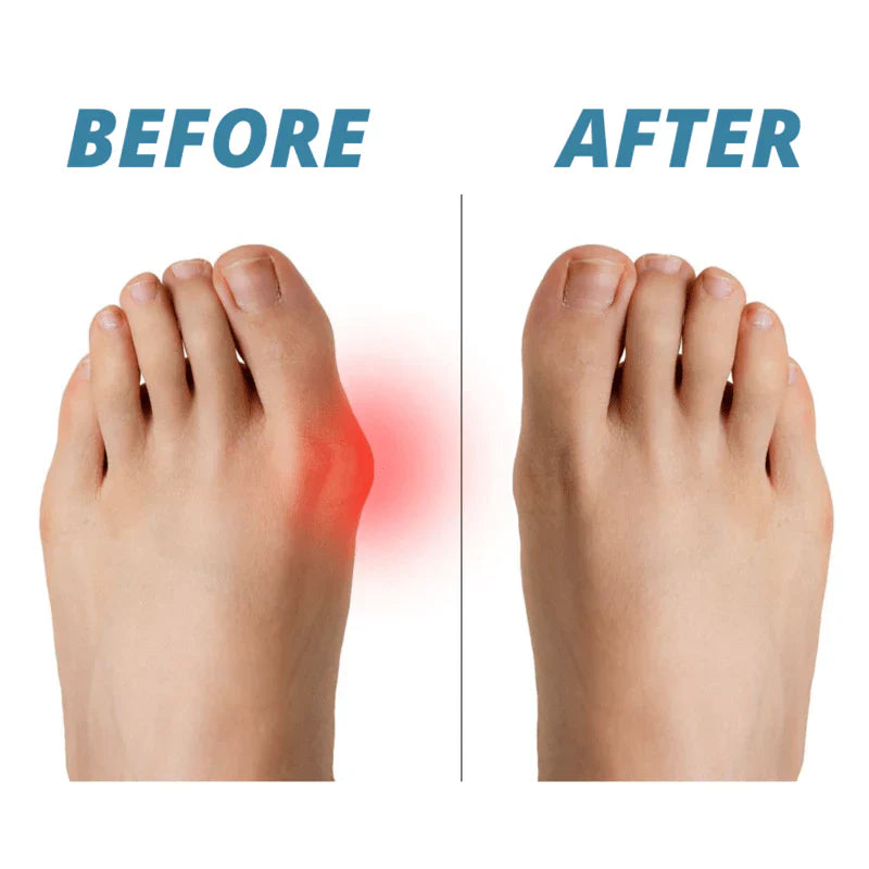 OrthoFit | Schmerzfreier Hallux-Valgus-Korrektor (2 Stück)