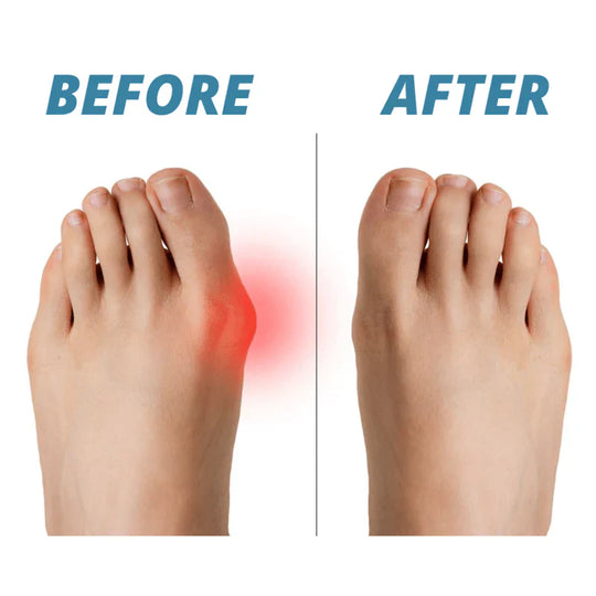 OrthoFit | Schmerzfreier Hallux-Valgus-Korrektor (2 Stück)