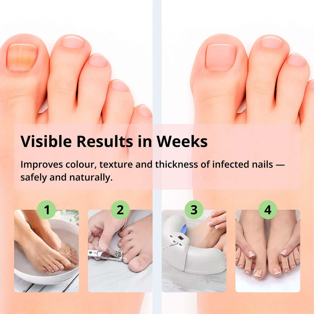 ClearNail | Laser-Nagelpilzgerät – Sicher & Effektiv für Zuhause