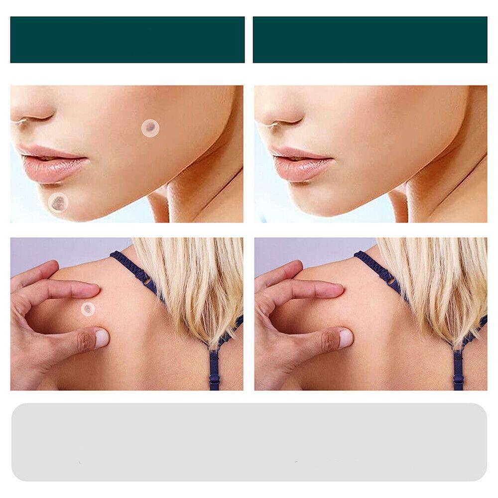 ClearDerm | Warzenentfernungsstreifen – Sicher & Bequem für Alle Hauttypen
