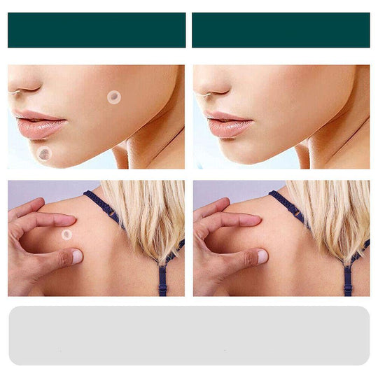 ClearDerm | Warzenentfernungsstreifen – Sicher & Bequem für Alle Hauttypen