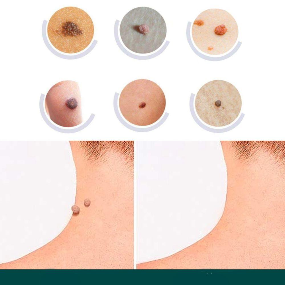 ClearDerm | Warzenentfernungsstreifen – Sicher & Bequem für Alle Hauttypen