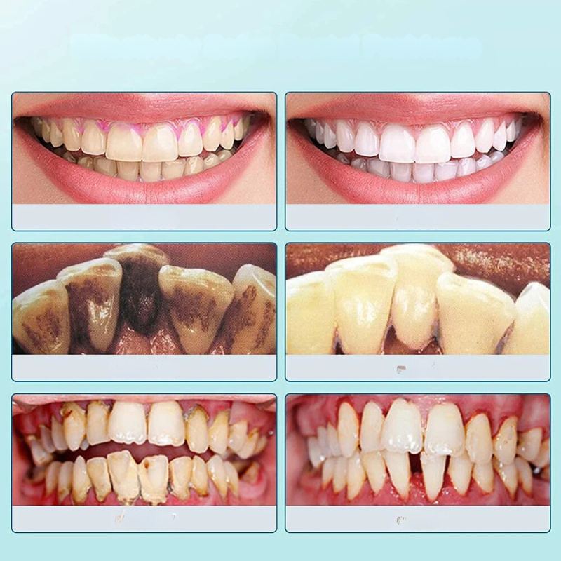 FreshScale | Ultraschall Plaque- und Zahnsteinentferner