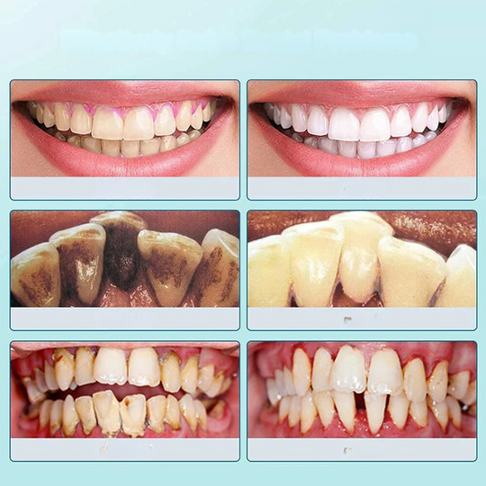 FreshScale | Ultraschall Plaque- und Zahnsteinentferner Decorique.de