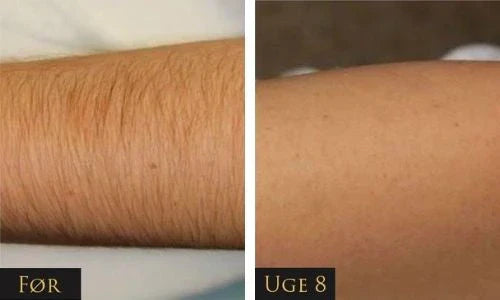 LumeaTouch | IPL – Dauerhafte Haarentfernung Decorique.de