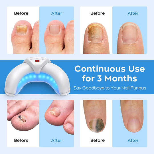 LumeNail | Schmerzfreie Laserbehandlung gegen Nagelpilz Decorique.de