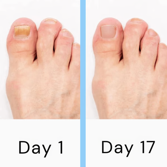 LumeNail | Schmerzfreie Laserbehandlung gegen Nagelpilz Decorique.de