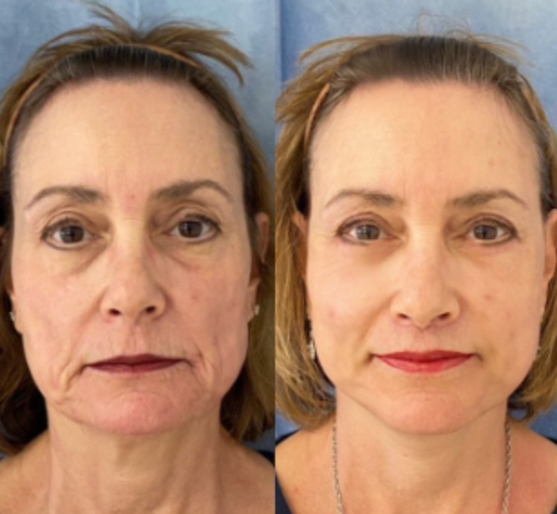 NanoBloom | Kollagen Augenmaske Decorique.de