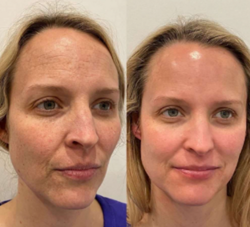 NanoBloom | Kollagen Augenmaske Decorique.de