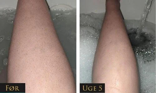 LumeaTouch | IPL – Dauerhafte Haarentfernung