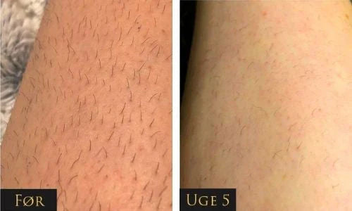 LumeaTouch | IPL – Dauerhafte Haarentfernung