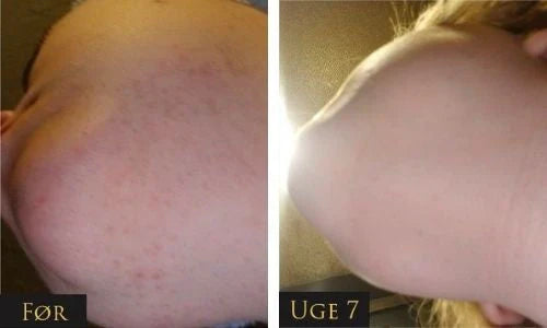 LumeaTouch | IPL – Dauerhafte Haarentfernung