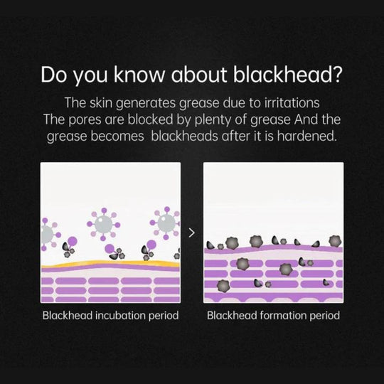 PurePore | Profi-Mitesserentferner für Klare Haut Decorique.de