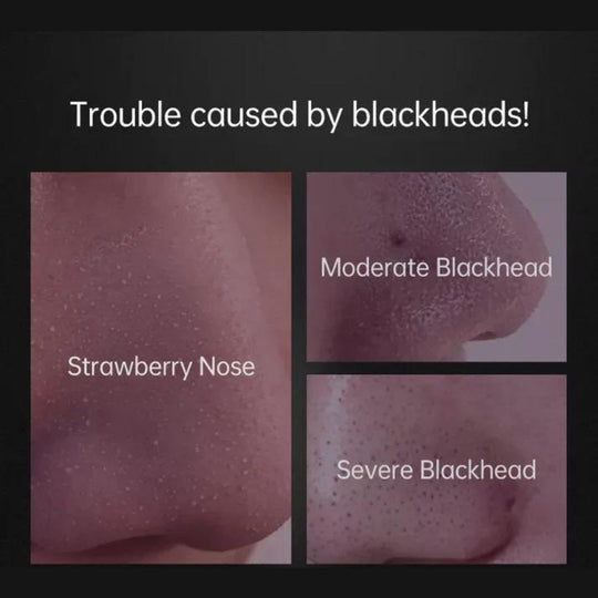 PurePore | Profi-Mitesserentferner für Klare Haut Decorique.de