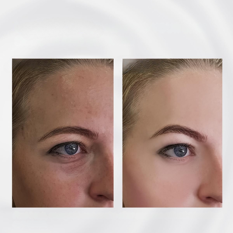 RadiantRoll | Edelstahl-Hautstraffungsgerät Decorique.de