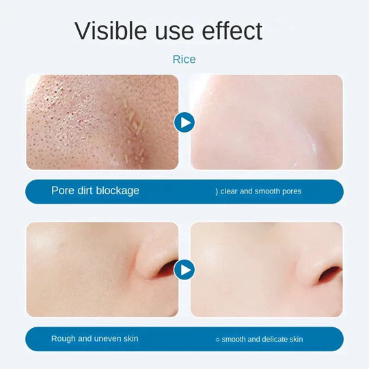 SkinFixx | Anti-Mitesser Reinigungskur im 5er-Set Decorique.de