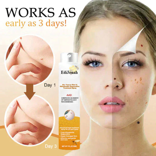 SkinPure | Warzen- & Hauttagspray – Schnell wirkend, Präzisionsdüse Decorique.de