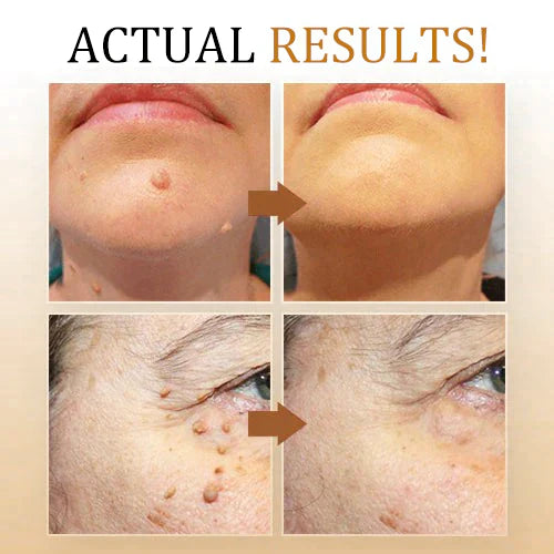 SkinPure | Warzen- & Hauttagspray – Schnell wirkend, Präzisionsdüse Decorique.de