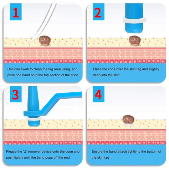 SkinTag | Hautwarzen Entfernungsset Decorique.de